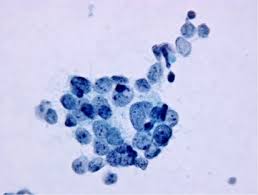 Merkel cell carcinoma is a skin cancer that is rare in type and needs immediate treatment. Update On Small Cell Carcinoma And Its Differentiation From Squamous Cell Carcinoma And Other Non Small Cell Carcinomas Modern Pathology