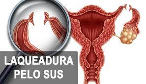 Laqueadura Pelo Sus 2022 Quem Pode Fazer Requisitos