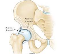 Reemplazo total de cadera (Total Hip Replacement ...