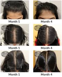 Age, sex, hormone and genetics play great roles in determining the quality as we … Best Hair Growth Treatment Uphairstyle