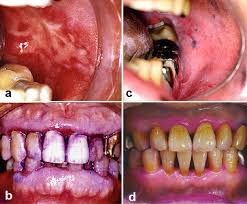 Image result for dental cancer