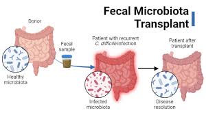 Image result for Fecal Transfer