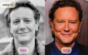 Judge Reinhold S Plastic Surgery For Facelift Before After Way Better Before Plastic Surgery Celebrity Plastic Surgery Plastic Surgery Photos
