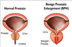 We did not find results for: Begnign Prostatic Hyperplasia Bph Symptoms Signs