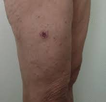 Eschar is composed of necrotic granulation tissue, muscle, fat, tendon or skin. Eschar Wiktionary