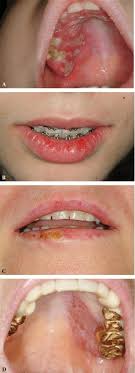 Herpes infections are very common. Examples Of Clinical Manifestation Of Herpes Simplex Virus Type 1 Download Scientific Diagram