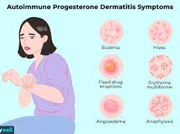 Allergic Reactions Related To The Menstrual Cycle