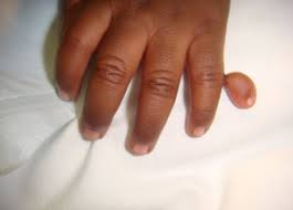 Deutlich sichtbar wird diese brustfehlbildung. Congenital Hand Deformities Spartanburg Hand Surgery