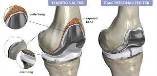 Knee Implants Customized Personalized Specialized Options Knee Implants Knee Replacement Knee Surgery