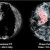 Staging and treatment of breast cancer. 1