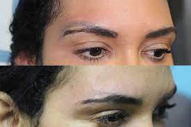 There are numerous benefits to this method of removal compared to other methods. Cosmetic And Eyebrow Tattoo Removal Removery