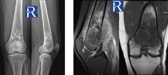 Image result for Osteosarcoma