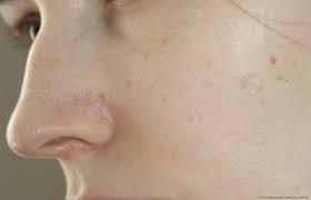 Woher kommt couperose und wie machen sie die äderchen unsichtbar? Entfernung Von Erweiterten Aderchen Per Laser Laserbehandlung Der Erweiterten Aderchen Auf Dem Gesicht Mein Empfinden Und Das Ergebnis Sind Die Schmerzen Und Kosten Es Wert Testberichte Bewertungen Meinungen