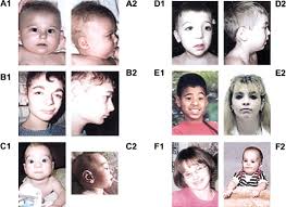 Here we generated induced pluripotent stem cells from 15 individuals with. Microduplication 22q11 2 An Emerging Syndrome Clinical Cytogenetic And Molecular Analysis Of Thirteen Patients Sciencedirect