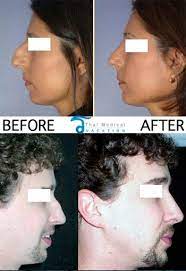 Reconstruction Rhinoplasty Nose Reshaping In Thailand Revision rhinoplasty for those who already had previous rhinoplasty but haven't satisfied with the rhinoplasty introduction. thai medical vacation