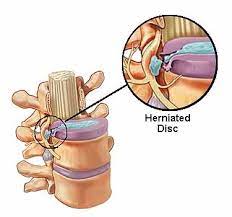 We did not find results for: Lumbar Herniated Disc