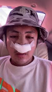 6th Revision Rhinoplasty with Goretex Surgiform