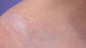 Pressure points can be prevented. White Spots On Skin What S Causing It