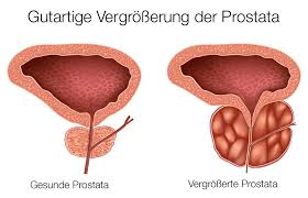 Explains prostate problems including prostatitis and benign prostatic hyperplasia. Operation Der Gutartigen Prostatavergrosserung Mit Kombinierter Tur Prostata Und Dioden Laser
