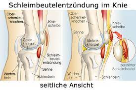 Schleimbeutelentzundung Bursitis Gesund Co At