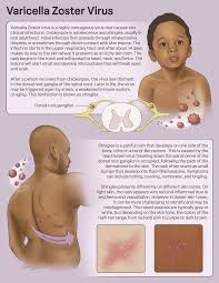 Image result for Varicella zoster on human skin