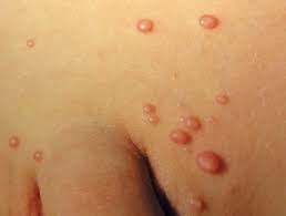 Maybe you would like to learn more about one of these? Molluscum Contagiosum Images Dermnet Nz
