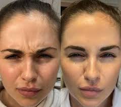 Wildflower Injections