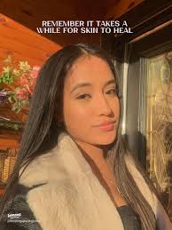 Effective Mexican Skin Care Routine for Acne-Prone Skin