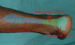 Stair stretch exercise to help recover from achilles tenosynovitis or paratenonitis: The Best Exercise For Insertional Achilles Tendon Pain Pogo Physio Gold Coast