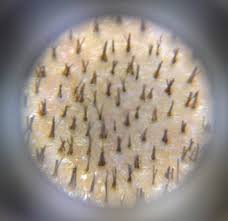 The area is cleaned with antimicrobial agents then the area is numbed with a local anesthetic. Scalp Dermoscopy Trichoscopy Dr Epstein