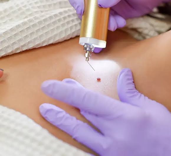 Wart and Mole Removal Dubai: Get Rid of Unwanted Skin Tags Safely