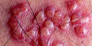 These 8 mushrooms that help beat herpes Bumps Hsv 2 Pictures On Buttocks