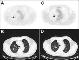 Ct scans can detect bone and joint problems, like complex bone fractures and tumors. For Early Stage Lung Cancer A New Biomarker And Treatment Target National Cancer Institute
