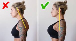 Neck hump (buffalo hump/dowager's hump) What Is Dowager S Hump And How To Fix It It S Not Only About Your Posture