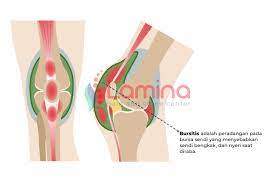 Maybe you would like to learn more about one of these? Bursitis Adalah Penyakit Penyebab Lutut Anda Sakit Klinik Patella