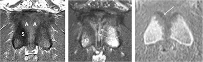 Image result for Pubic Apophysitis