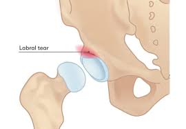 Image result for Hip Labral Tear
