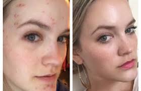 The Hidden Cause of Acne