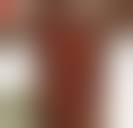 Image result for Pemphigus