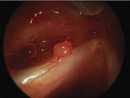 Image result for Acute Laryngitis
