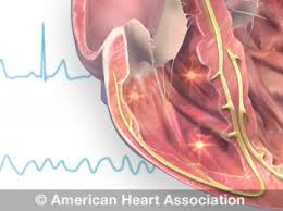 Tachycardia Fast Heart Rate American Heart Association