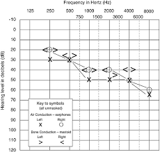 We did not find results for: 3 Assessment Of The Auditory System And Its Functions Hearing Loss Determining Eligibility For Social Security Benefits The National Academies Press