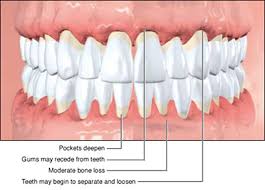 classifications of periodontal diseases professional