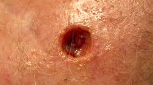Image result for Merkel Cell Carcinoma
