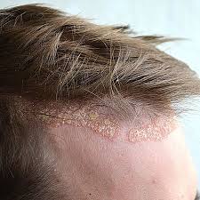 Image result for dry scabs on the head in children