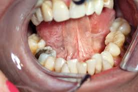 It can begin in the lips, tongue, gums,. A New Look At Oral Dysplasia Oral Health Group