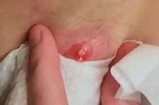 Sebaceous cyst popping at home. Stomach Churning Video Shows Cyst Being Drained From Man S Neck What Comes Out Is Truly Disgusting Mirror Online