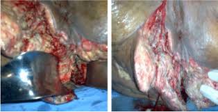 The primary symptom of fournier disease is severe pain and redness in the scrotum. Fournier S Gangrene Descriptive Analysis And Outcome Of Eleven Cases