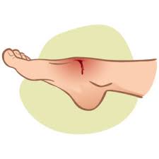 With tenor, maker of gif keyboard, add popular feet hurt animated gifs to your conversations. This Is Why Wounds On Your Feet Aren T Healing Silverman Ankle Foot