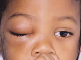 Image result for ORBITAL INFARCTION IN SICKLE CELL DISEASE